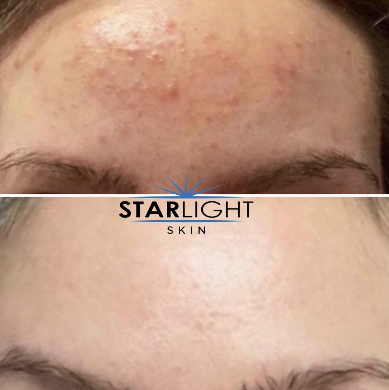 Before and after Starlight Skin treatment — clearer skin, calmer breakouts
