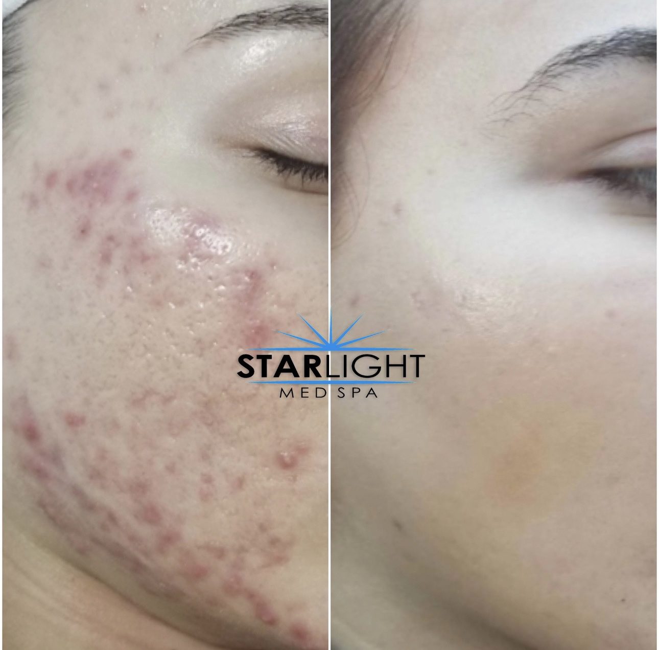 Before and after Starlight Skin treatment — clearer skin, calmer breakouts