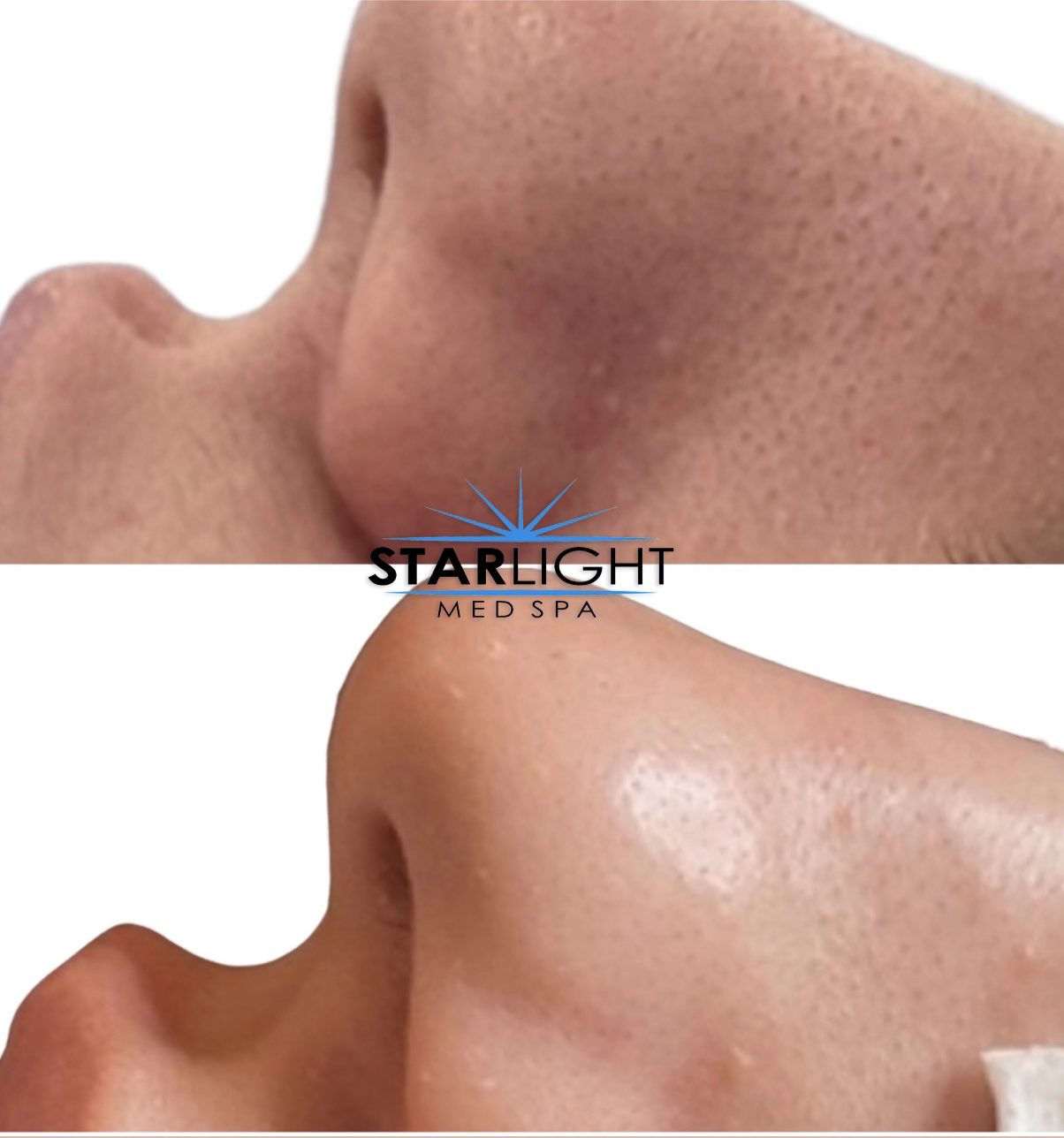 Before and after Starlight Skin treatment — smoother texture and softened scarring